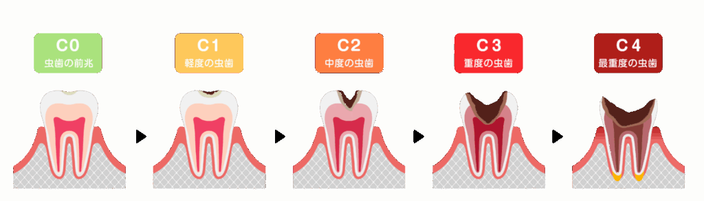虫歯の進行｜こばやし歯科
