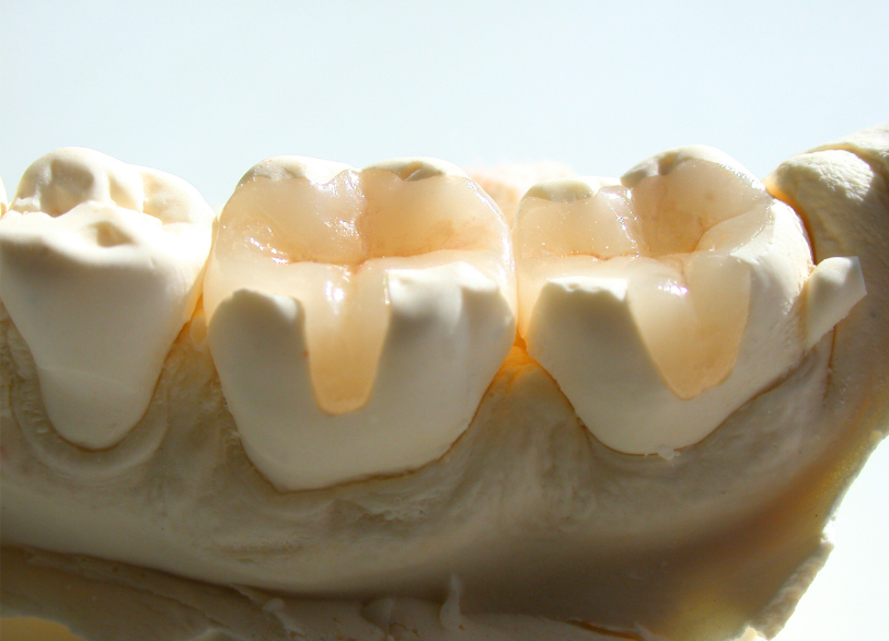 銀歯や古い詰め物を白くしたい｜こばやし歯科