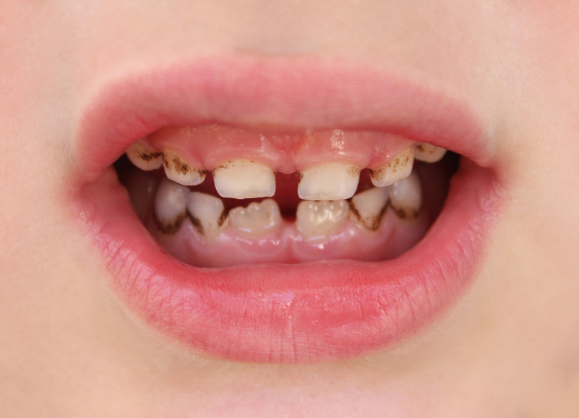 乳歯の虫歯の特徴｜こばやし歯科