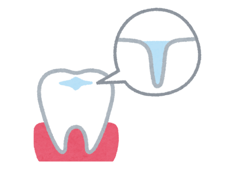 シーラント｜こばやし歯科