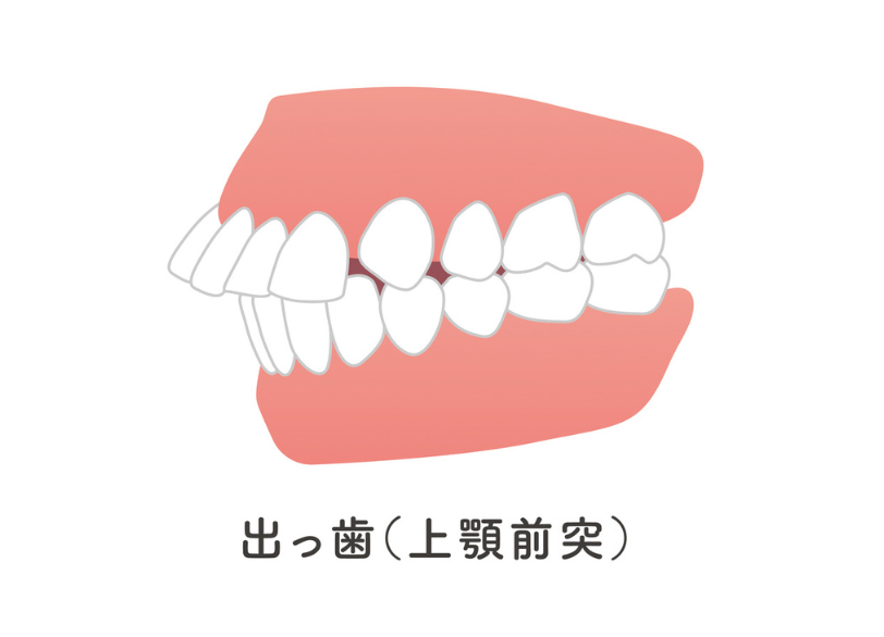 出っ歯｜こばやし歯科