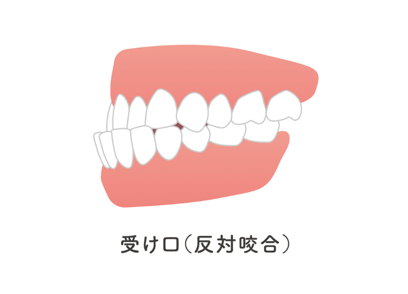 受け口｜こばやし歯科