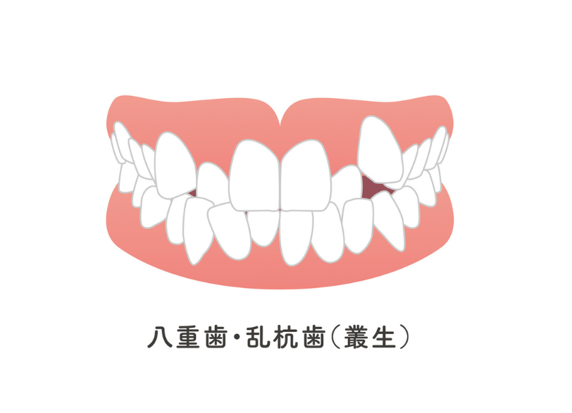 叢生｜こばやし歯科