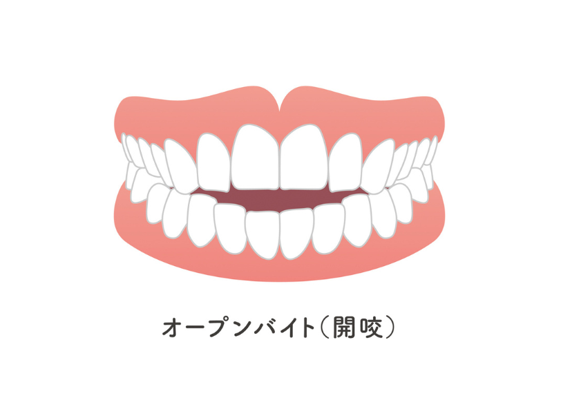 開咬｜こばやし歯科