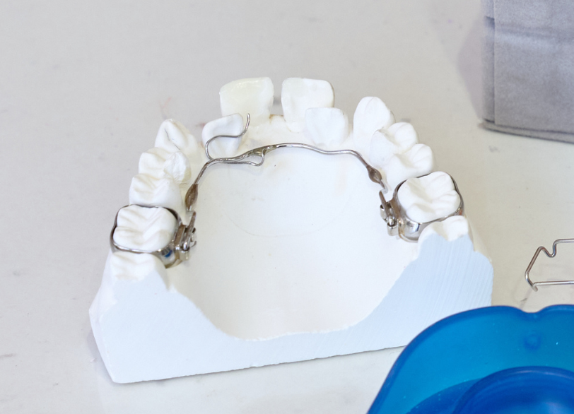 リンガルアーチ｜こばやし歯科