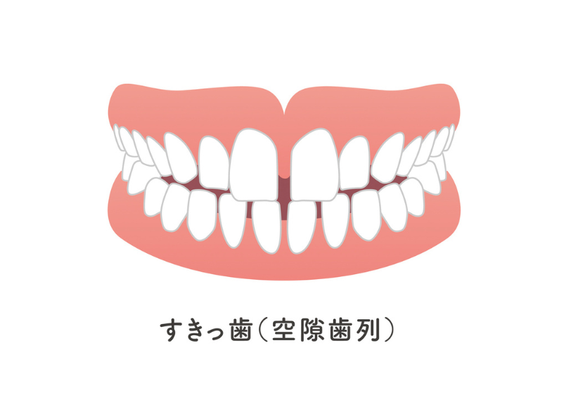 すきっ歯|こばやし歯科