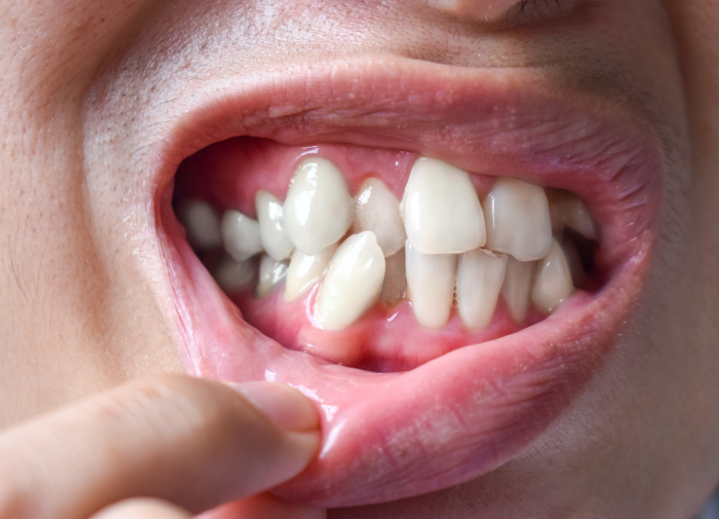 長くご自身の歯を使い続けるために|こばやし歯科