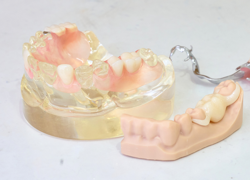 ノンクラスプデンチャー｜こばやし歯科