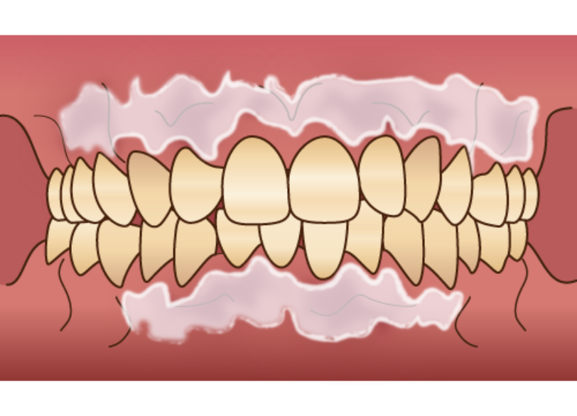 ケミカルピーリング｜こばやし歯科