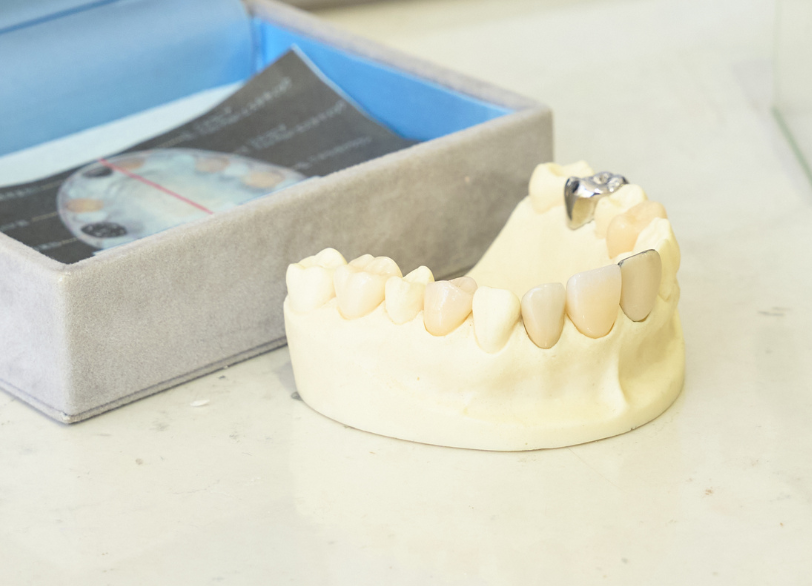 セラミック治療｜こばやし歯科