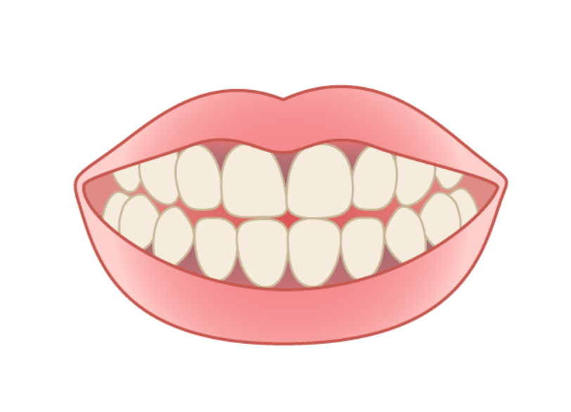 歯茎が黒ずんでしまうのはなぜ？｜こばやし歯科
