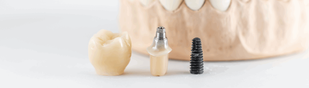 インプラントとの比較｜こばやし歯科