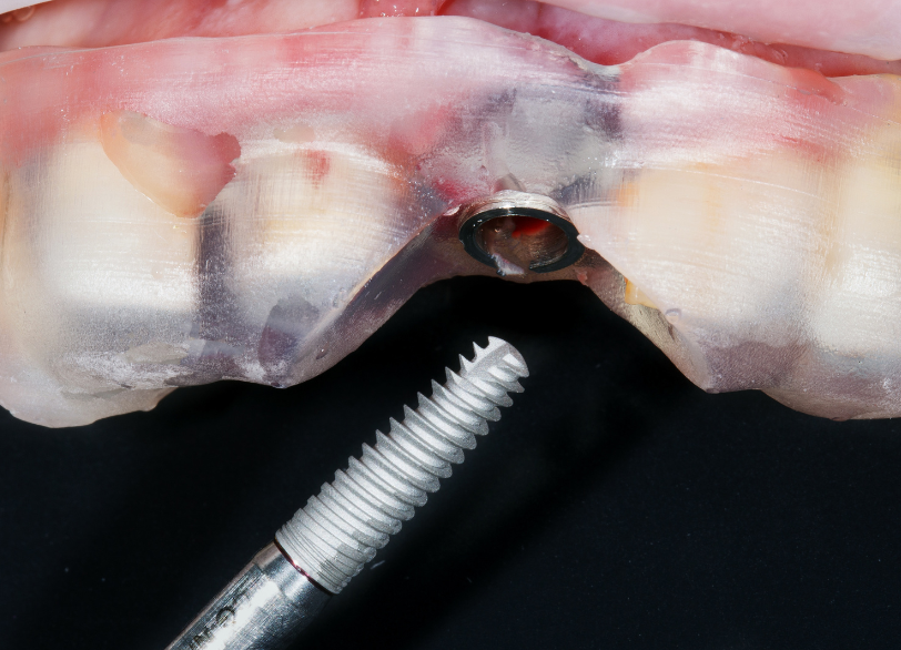 サージカルガイド｜こばやし歯科