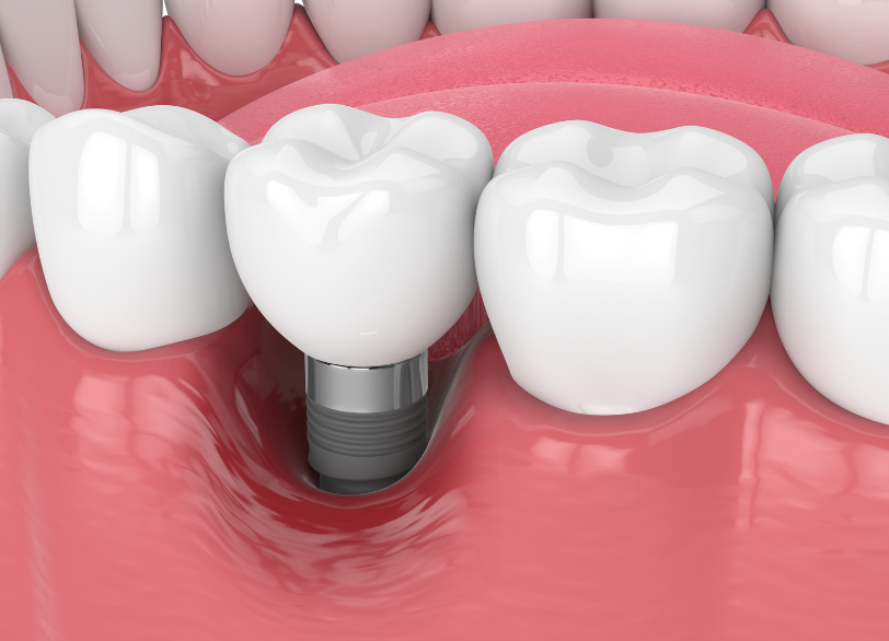 インプラント周囲炎｜こばやし歯科