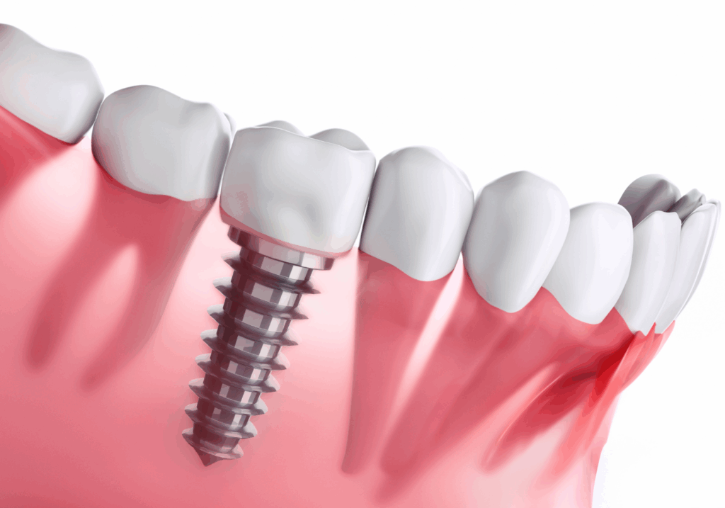 インプラント｜こばやし歯科