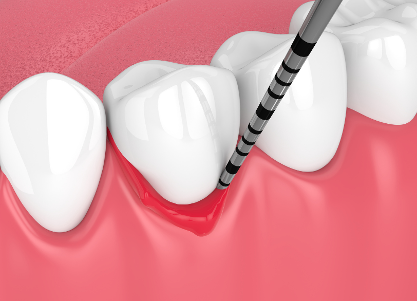 歯周病｜こばやし歯科