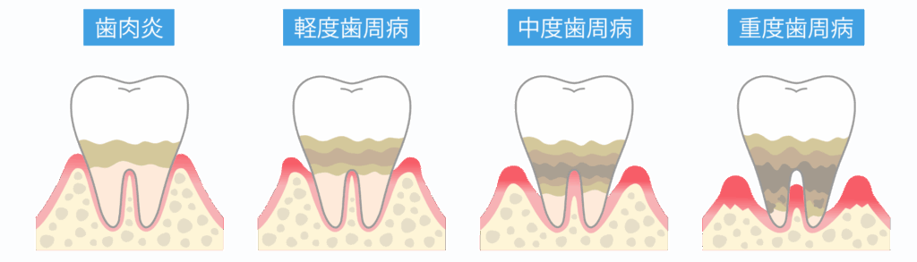 歯周病の進行｜こばやし歯科