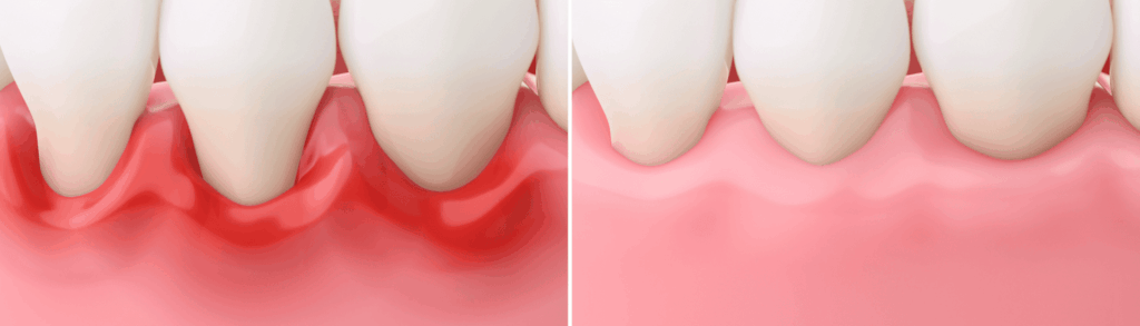 歯周組織再生療法｜こばやし歯科