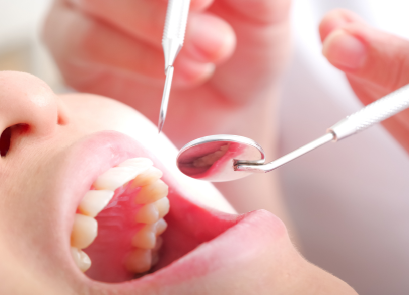 プロフェッショナルケアの重要性｜こばやし歯科