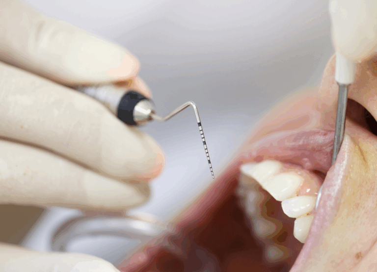 歯周ポケット検査｜こばやし歯科