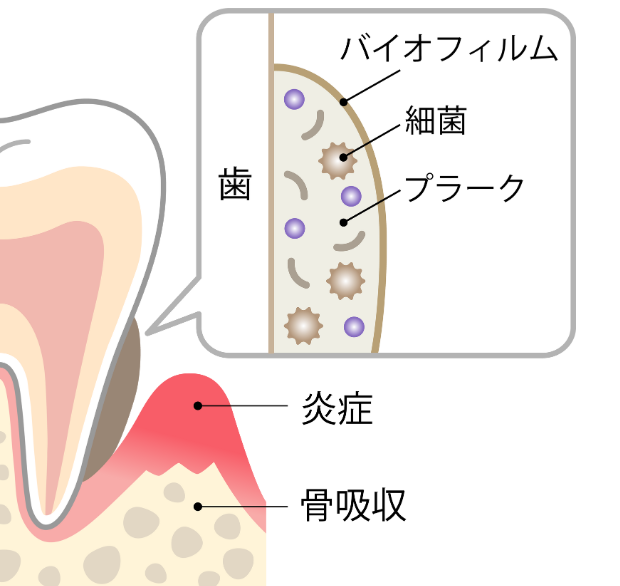 バイオフィルム｜こばやし歯科