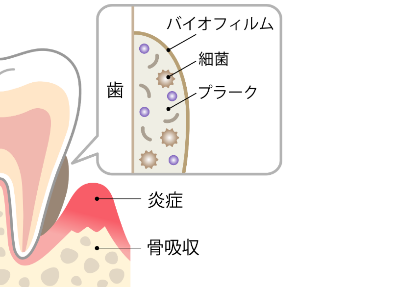 バイオフィルム｜こばやし歯科