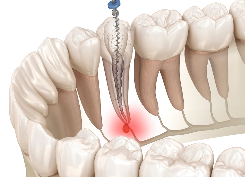 超音波洗浄｜こばやし歯科