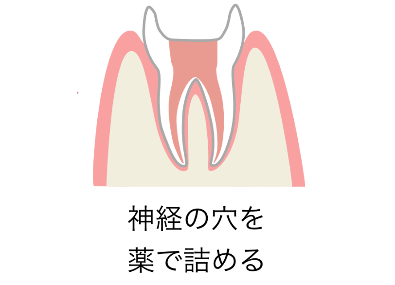 精密な根管充填｜こばやし歯科