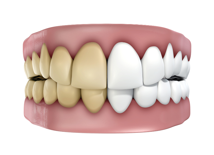 歯が黄ばむのはなぜ？｜こばやし歯科