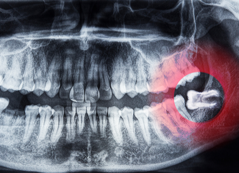 親知らずとは｜こばやし歯科