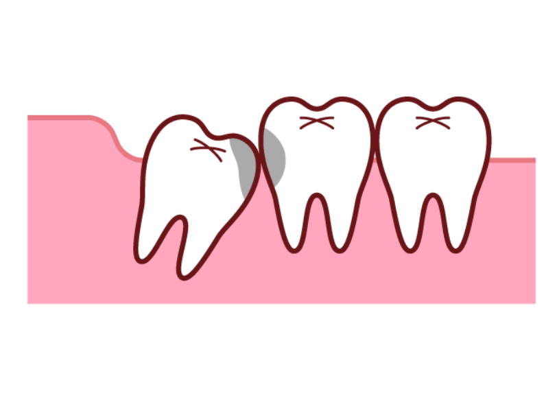 虫歯・歯周病｜こばやし歯科