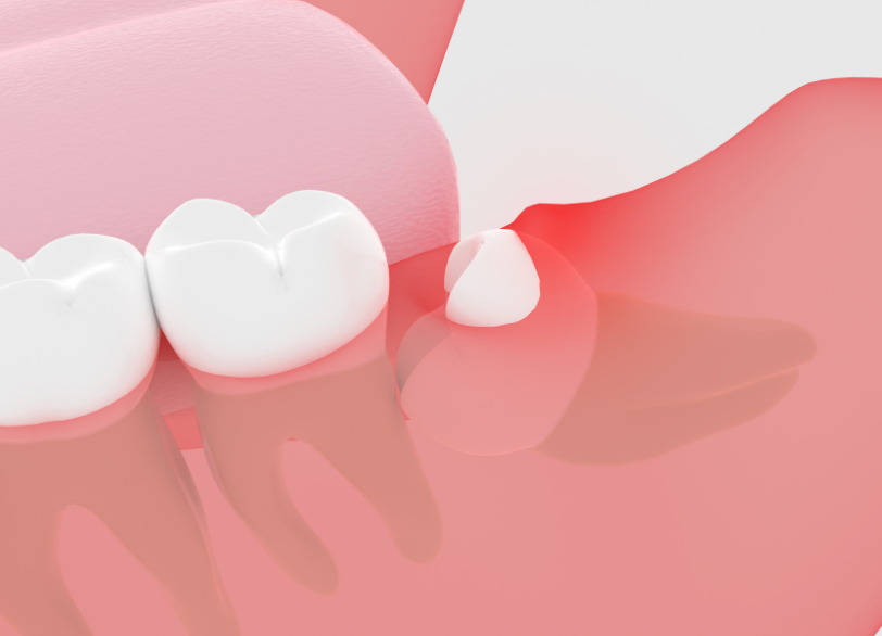 智歯周囲炎｜こばやし歯科