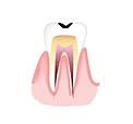 むし歯の進行別治療法